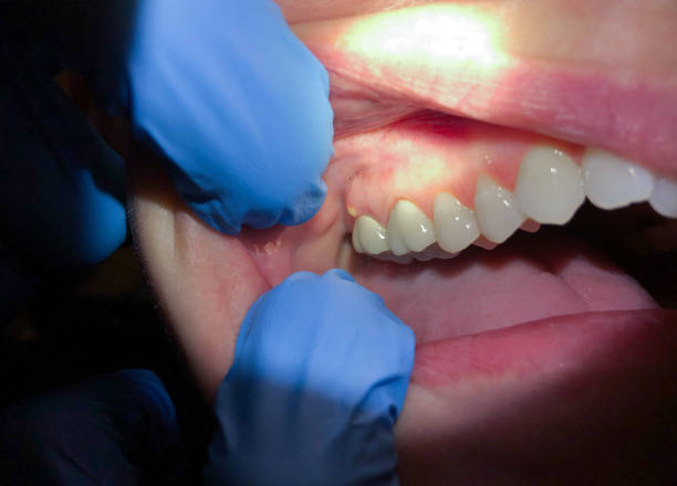 Best Emergency Wisdom Tooth Extraction in La Follette, TN